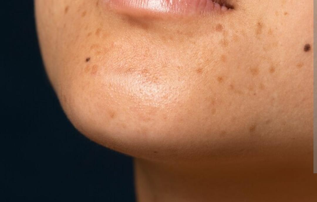 علاج التصبغات، الندبات، وتوسع المسام